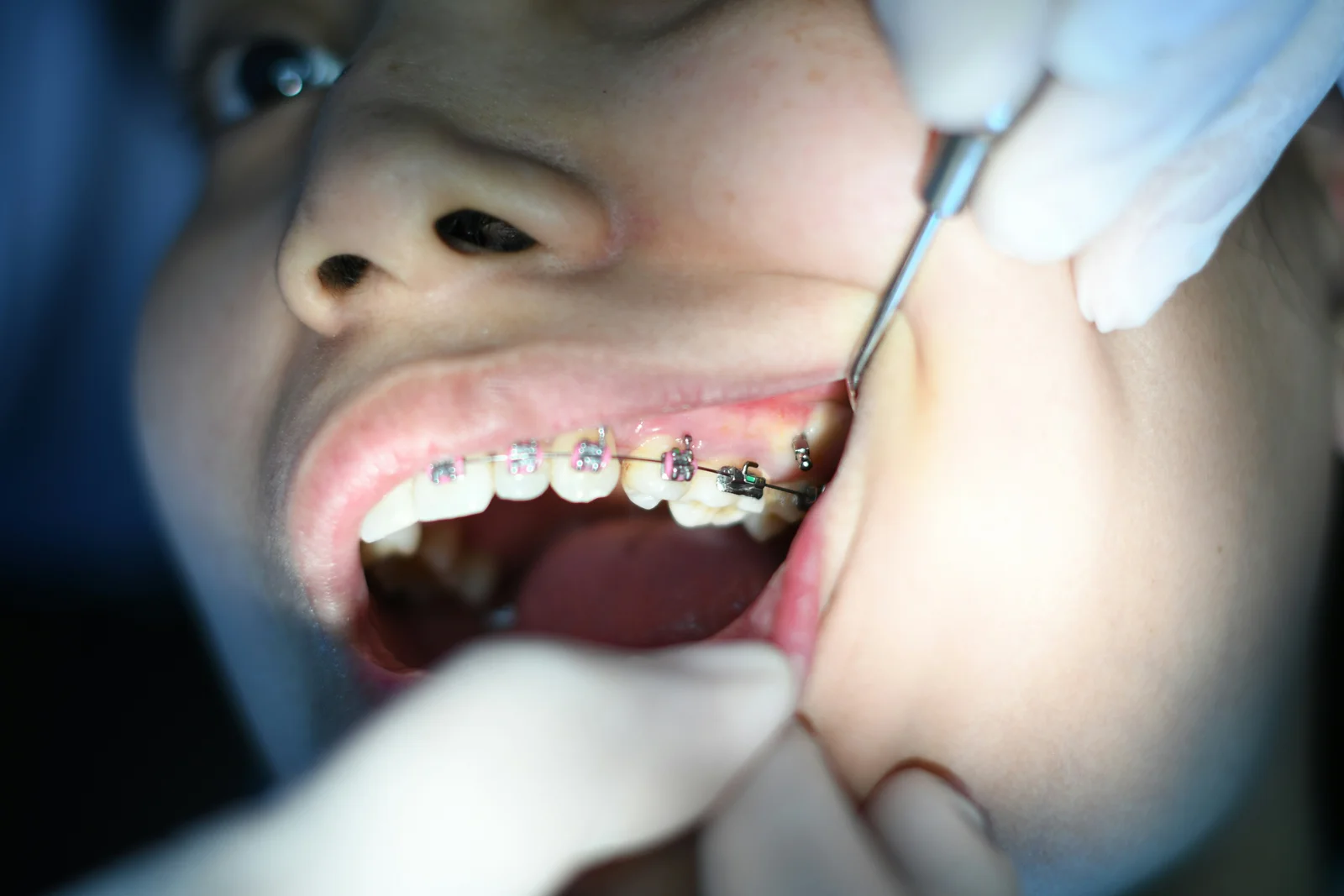 Consultație ortodontică pentru aparat dentar la SamiDent PLUS în București Sector 2